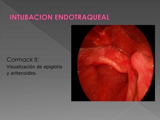 Distancia esternomentoniana.
