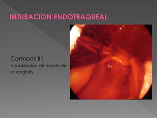 Distancia Interincisivos.INTUBACION ENDOTRAQUEAL    CLASIF. MALLAMPATIGrado I: paladar blando + pilares + úvulaGrado II: paladar blando + pilares + base de úvulaGrado III: sólo se ve el paladar blando Grado IV: no se logra ver el paladar blandoGrado I y II: predice intubación fácil	Grado III y IV: predice cierta dificultad para intubar