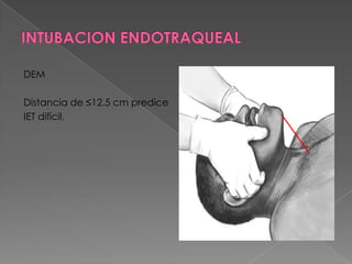 INTUBACION ENDOTRAQUEALCormack III: Visualización del borde de la epiglotis.