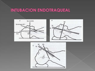 INTUBACION ENDOTRAQUEALDEMDistancia de ≤12.5 cm predice IET difícil.
