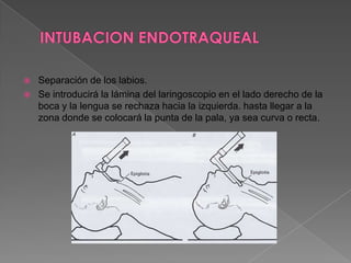 INTUBACION ENDOTRAQUEAL