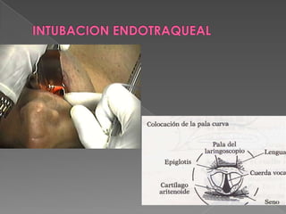 INTUBACION ENDOTRAQUEALINTUBACION PROPIAMENTE DICHATomar el mango del laringoscopio con mano izquierda.
