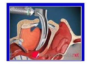 Intubacion endotraqueal | PDF