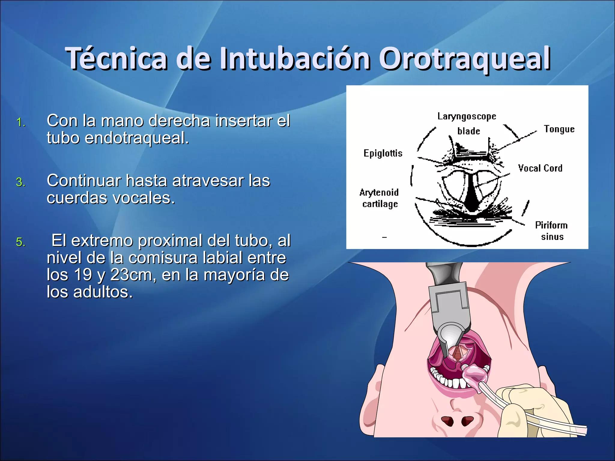Intubacion endotraqueal | PPT | Lung and Respiratory Health | Diseases ...