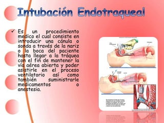 Intubacion Endotraqueal | PPT