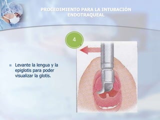  Levante la lengua y la
epiglotis para poder
visualizar la glotis.
PROCEDIMIENTO PARA LA INTUBACIÓN
ENDOTRAQUEAL
4
 