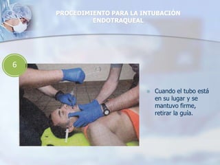  Cuando el tubo está
en su lugar y se
mantuvo firme,
retirar la guía.
PROCEDIMIENTO PARA LA INTUBACIÓN
ENDOTRAQUEAL
6
 