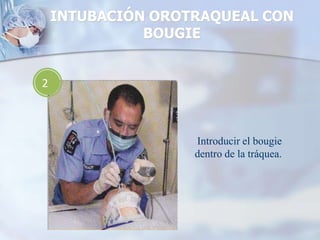 2
Introducir el bougie
dentro de la tráquea.
INTUBACIÓN OROTRAQUEAL CON
BOUGIE
 