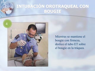 INTUBACIÓN OROTRAQUEAL CON
BOUGIE
4
Mientras se mantiene el
bougie con firmeza,
deslice el tubo ET sobre
el bougie en la tráquea.
 