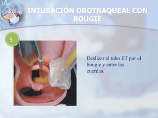 INTUBACIÓN OROTRAQUEAL CON
BOUGIE
5
Deslizar el tubo ET por el
bougie y entre las
cuerdas.
 
