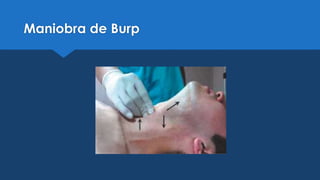Intubacion orotraqueal | PPTX