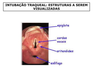 INTUBAÇÃO TRAQUEAL: ESTRUTURAS A SEREM
VISUALIZADAS
 