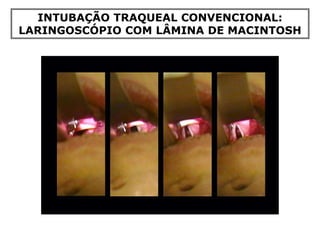 INTUBAÇÃO TRAQUEAL CONVENCIONAL:
LARINGOSCÓPIO COM LÂMINA DE MACINTOSH
 