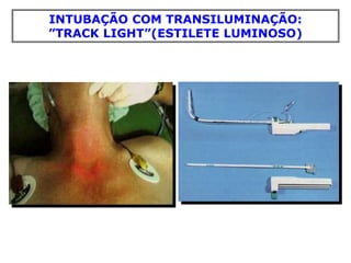 INTUBAÇÃO COM TRANSILUMINAÇÃO:
”TRACK LIGHT”(ESTILETE LUMINOSO)
 