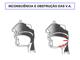 Paciente lúcido Paciente inconsciente
INCONSCIÊNCIA E OBSTRUÇÃO DAS V.A.
 