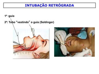 1º :guia
2º: Tubo “vestindo” o guia (Seldinger)
INTUBAÇÃO RETRÓGRADA
 