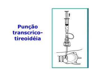 Punção
transcrico-
tireoidéia
 