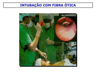 INTUBAÇÃO COM FIBRA ÓTICA
 