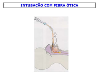 INTUBAÇÃO COM FIBRA ÓTICA
 
