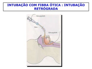 INTUBAÇÃO COM FIBRA ÓTICA : INTUBAÇÃO
RETRÓGRADA
 