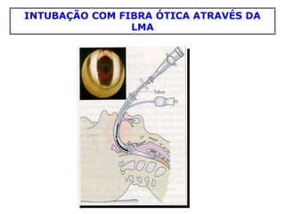 INTUBAÇÃO COM FIBRA ÓTICA ATRAVÉS DA
LMA
 