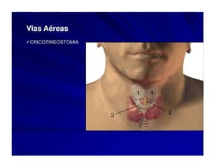 intubação-traqueal-.ppt