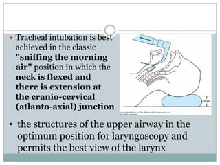 Tracheal intubation is best

achieved in the classic
"sniffing the morning
air" position in which the
neck is flexed and
there is extension at
the cranio-cervical
(atlanto-axial) junction

• the structures of the upper airway in the
optimum position for laryngoscopy and
permits the best view of the larynx

 