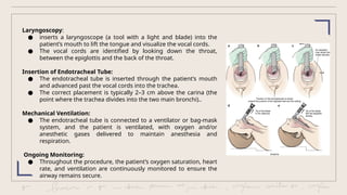 Intubation - describtion, diagnosis and management | PPTX