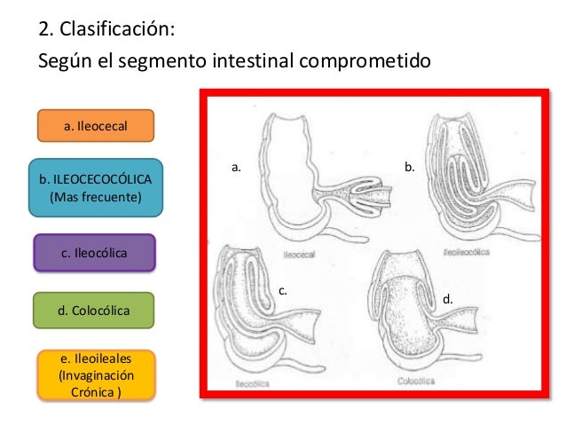 Intuscepcion o invaginacion intestinal