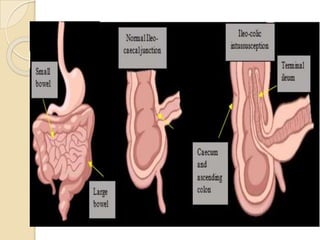 Intersection Intestinal INTUSSUCEPTION.pptx