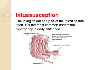 Intussusception
The invagination of a part of the intestine into
itself. It is the most common abdominal
emergency in early childhood
 