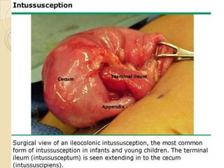 Intussusception in children | PPTX