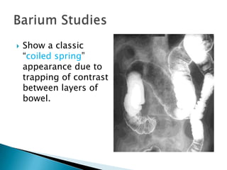 Intussusception | PPTX