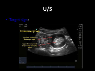 U/S 
• Target sign: 
 