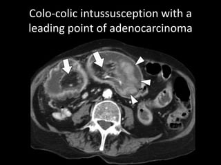 Colo-colic intussusception with a 
leading point of adenocarcinoma 
 