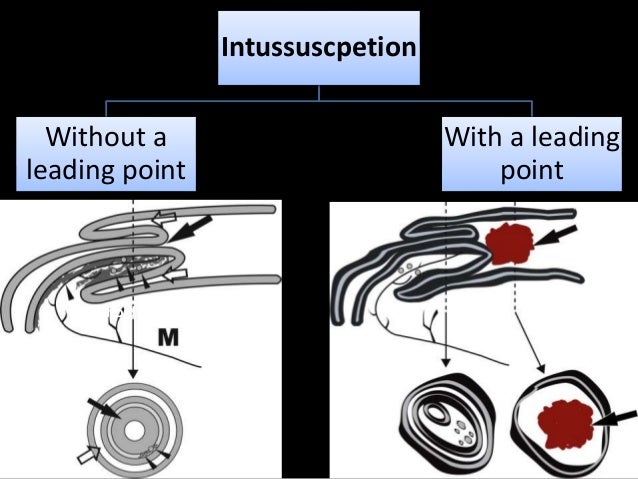 Intussusception