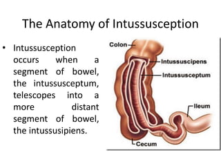 Intersection Intestinal Intussusception | PPTX