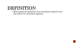  Telescoping invagination of an intestinal segment into
the lumen of a proximal segment.
 