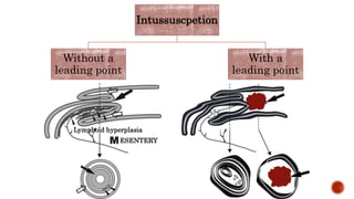 Intussuscpetion
Without a
leading point
With a
leading point
ESENTERY
Lymphoid hyperplasia
 