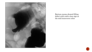 Barium enema showed filling
defect with crab's claw sign at
the mid transverse colon
 