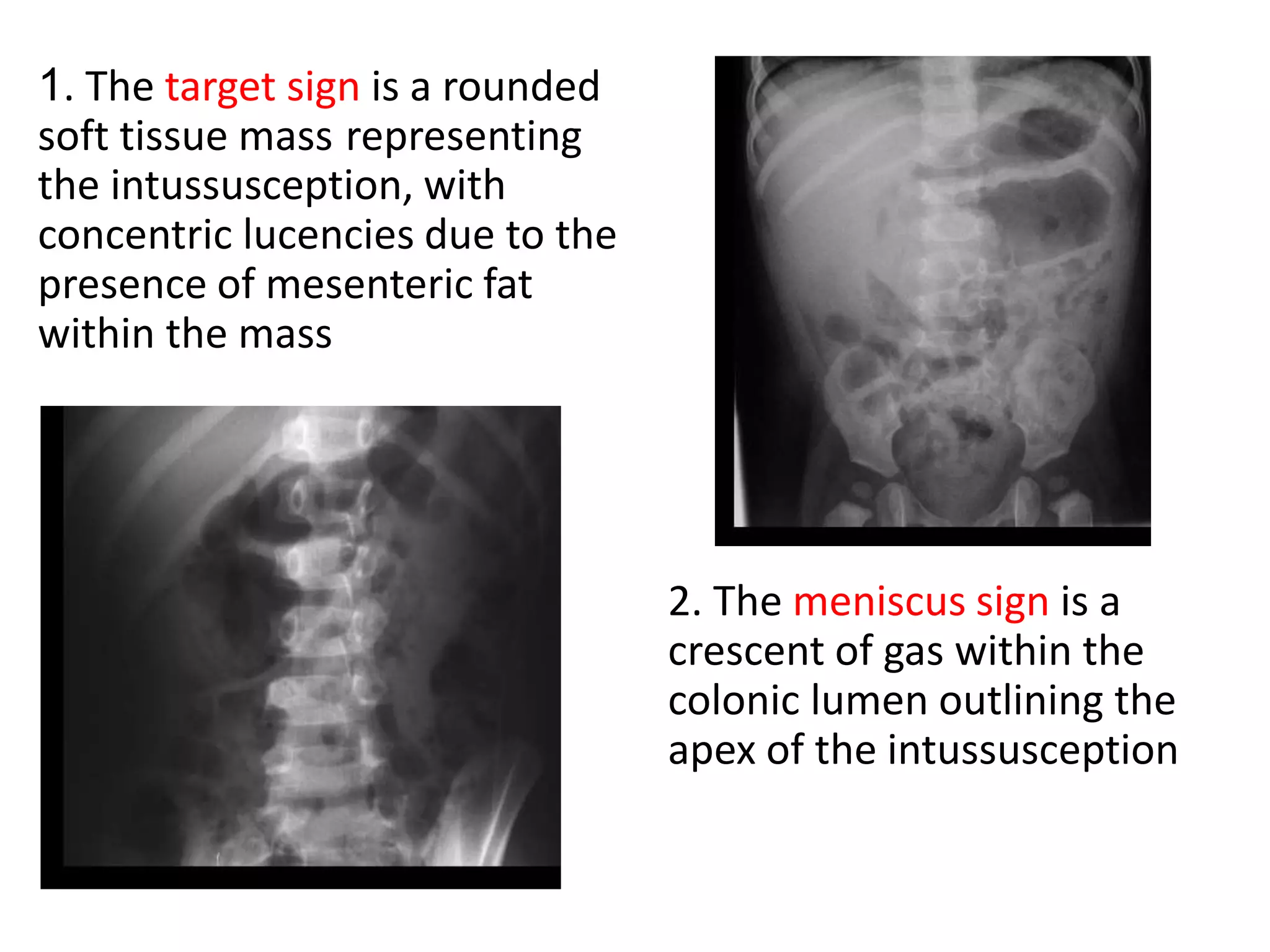 2. The meniscus sign is a
crescent of gas within the
colonic lumen outlining the
apex of the intussusception
1. The target sign is a rounded
soft tissue mass representing
the intussusception, with
concentric lucencies due to the
presence of mesenteric fat
within the mass
 