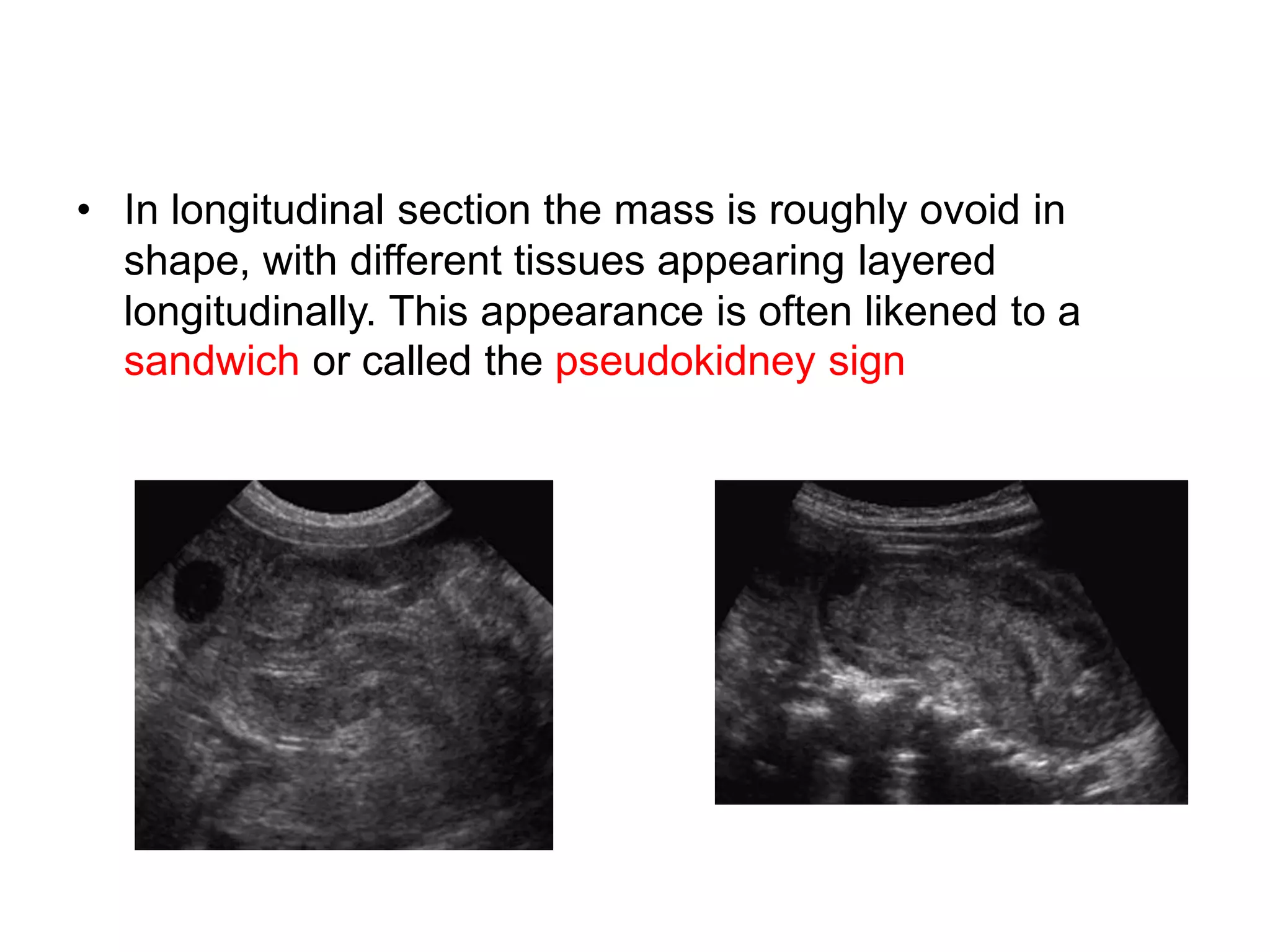 • In longitudinal section the mass is roughly ovoid in
shape, with different tissues appearing layered
longitudinally. This appearance is often likened to a
sandwich or called the pseudokidney sign
 