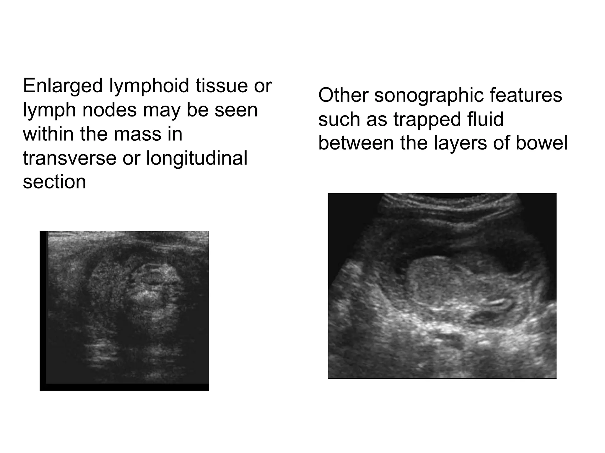 Enlarged lymphoid tissue or
lymph nodes may be seen
within the mass in
transverse or longitudinal
section
Other sonographic features
such as trapped fluid
between the layers of bowel
 