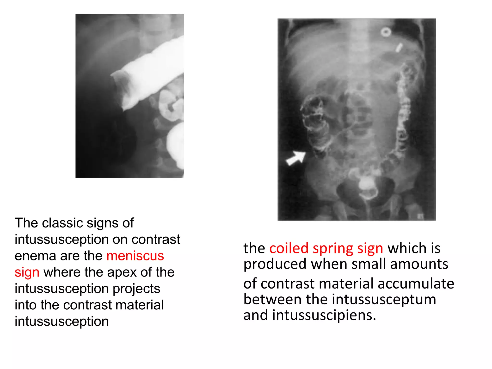 the coiled spring sign which is
produced when small amounts
of contrast material accumulate
between the intussusceptum
and intussuscipiens.
The classic signs of
intussusception on contrast
enema are the meniscus
sign where the apex of the
intussusception projects
into the contrast material
intussusception
 
