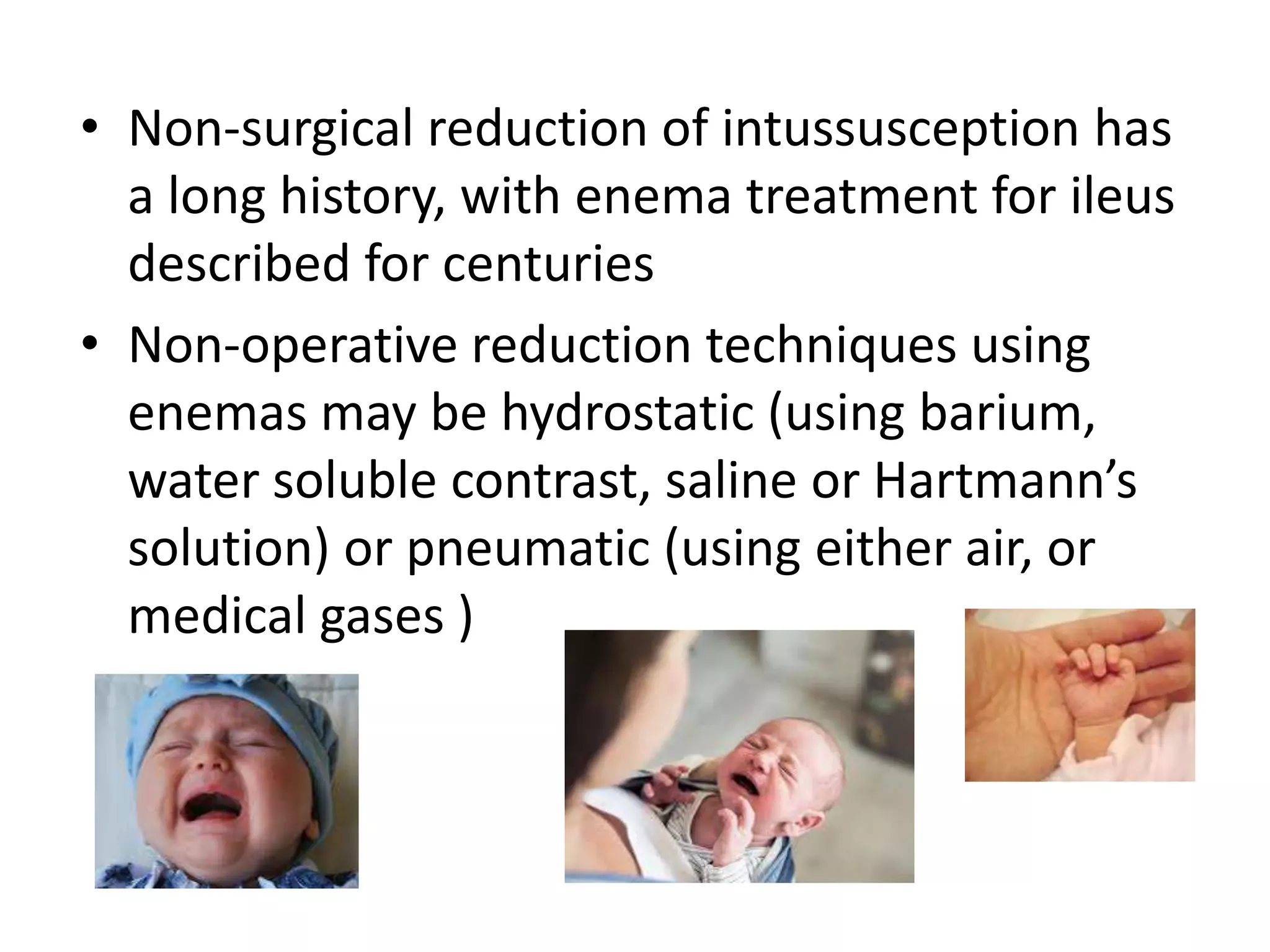 • Non-surgical reduction of intussusception has
a long history, with enema treatment for ileus
described for centuries
• Non-operative reduction techniques using
enemas may be hydrostatic (using barium,
water soluble contrast, saline or Hartmann’s
solution) or pneumatic (using either air, or
medical gases )
 