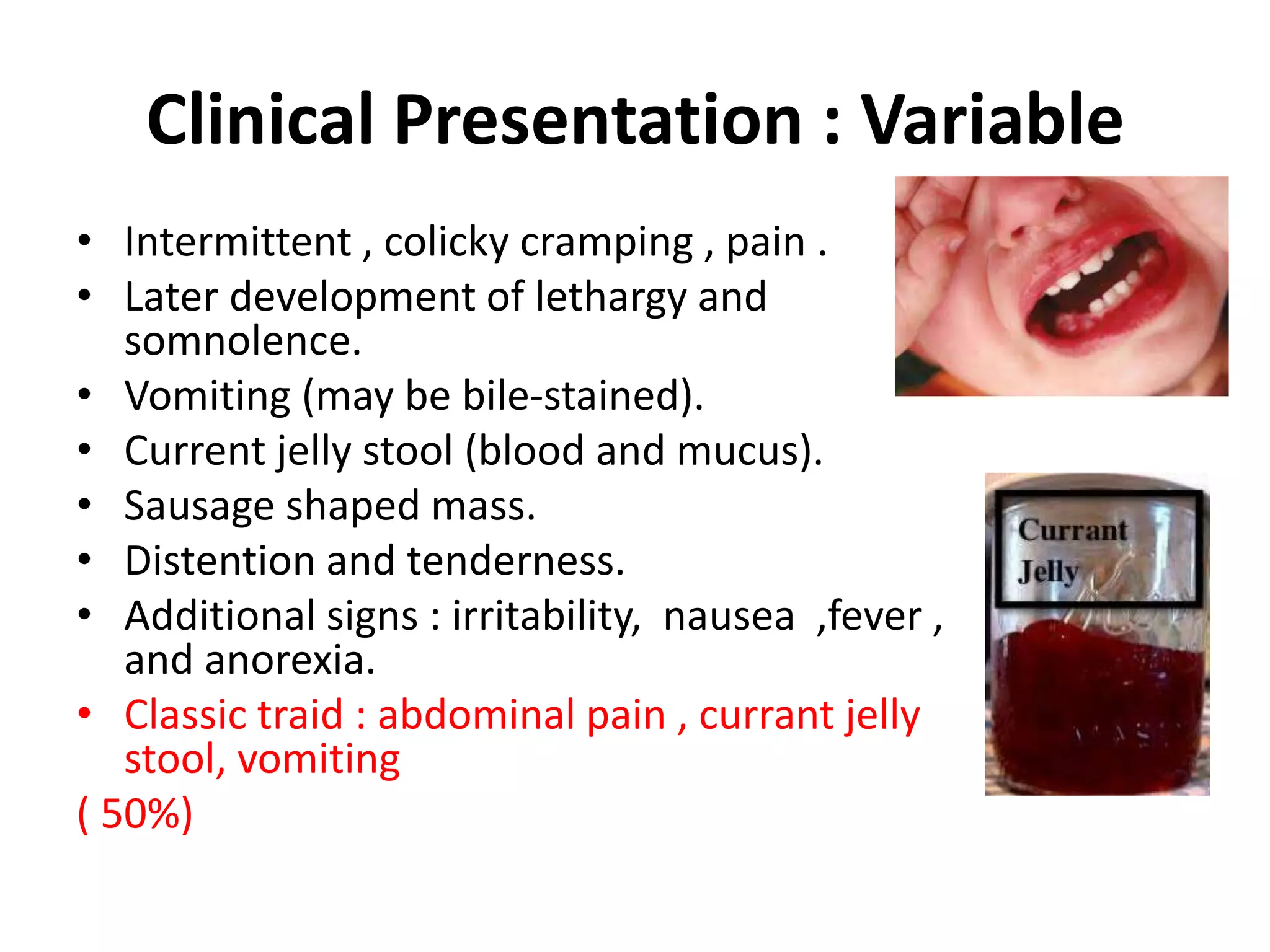 Clinical Presentation : Variable
• Intermittent , colicky cramping , pain .
• Later development of lethargy and
somnolence.
• Vomiting (may be bile-stained).
• Current jelly stool (blood and mucus).
• Sausage shaped mass.
• Distention and tenderness.
• Additional signs : irritability, nausea ,fever ,
and anorexia.
• Classic traid : abdominal pain , currant jelly
stool, vomiting
( 50%)
 