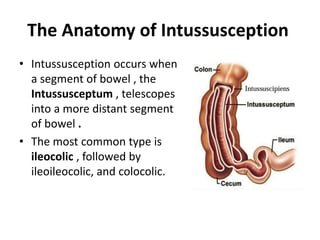 Intussusception | PPTX | Digestive Disorders | Diseases and Conditions