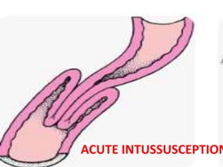 ACUTE INTUSSUSCEPTION
 