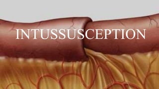 INTUSSUSCEPTION
 