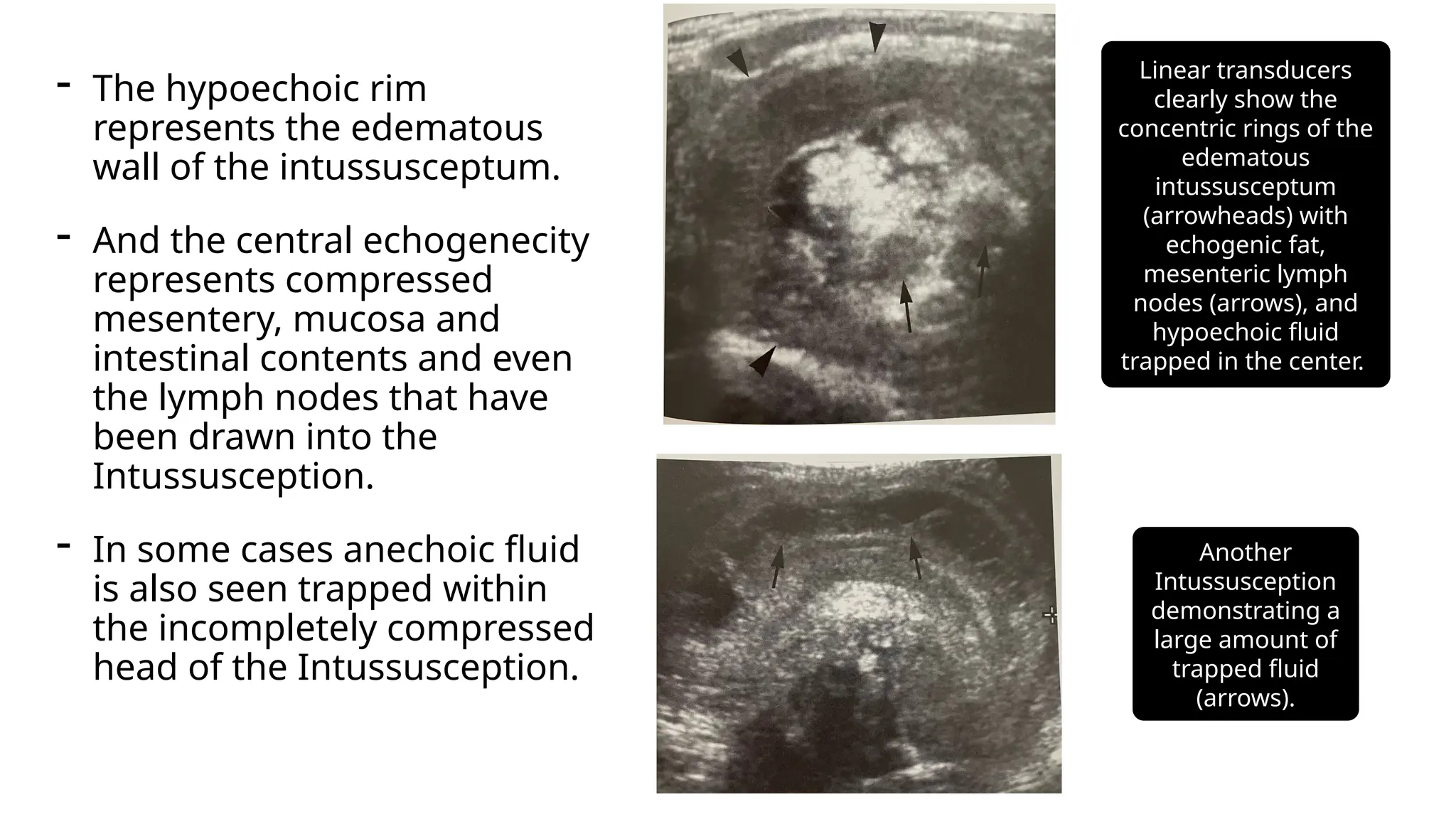 Claw Pincer Sign Intussusception